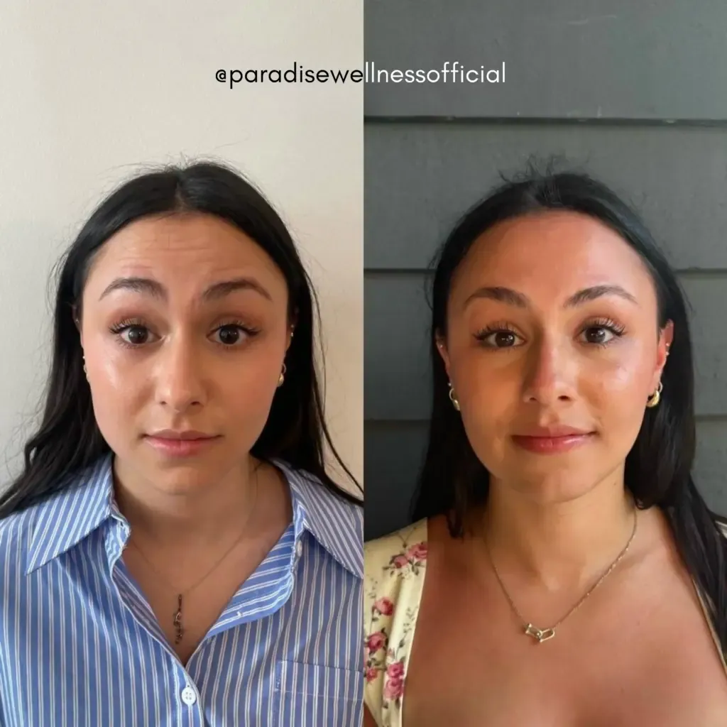 Baby Botox for forehead and frown lines results
