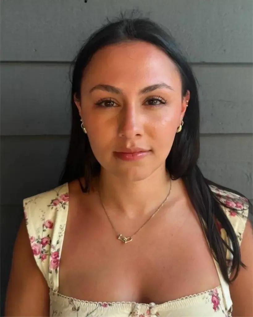 baby botox treatment result after image at paradise wellness