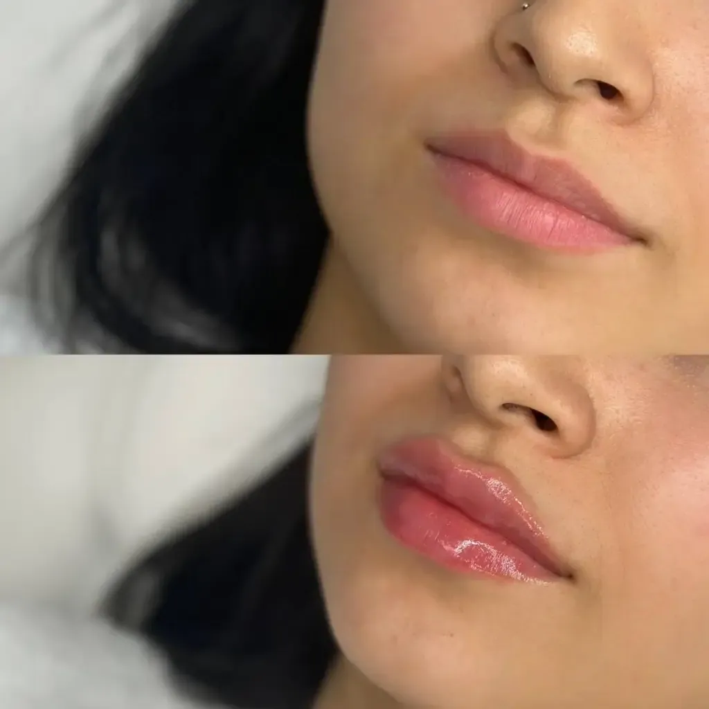 Before and after image of lip filler in Delhi showing natural enhancement and symmetry correction