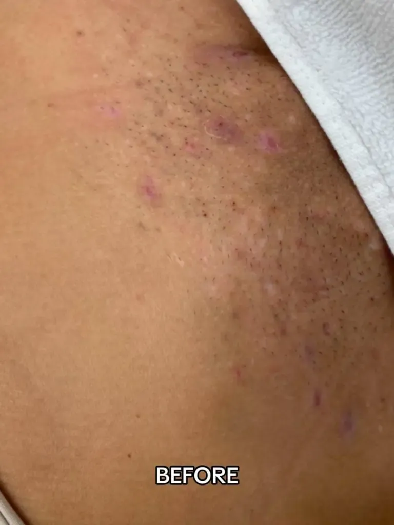  A side-by-side photo showing natural Bikini Laser Hair Removal results at Paradise Wellness.
