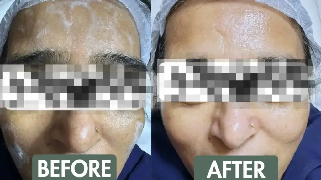 Before and after results of bridal skin treatments in Delhi showing brighter, even skin tone